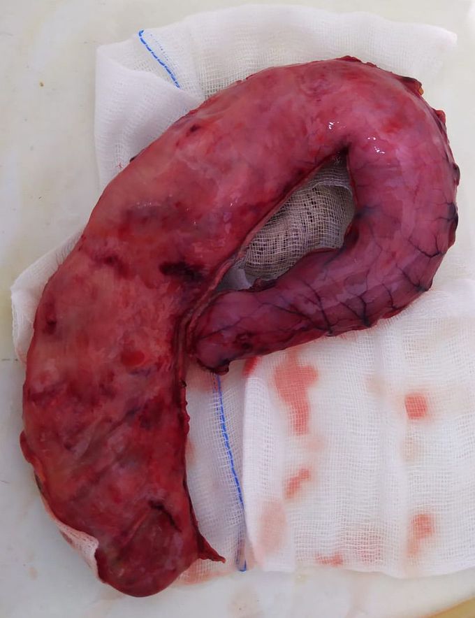 Sleeve gastrectomy