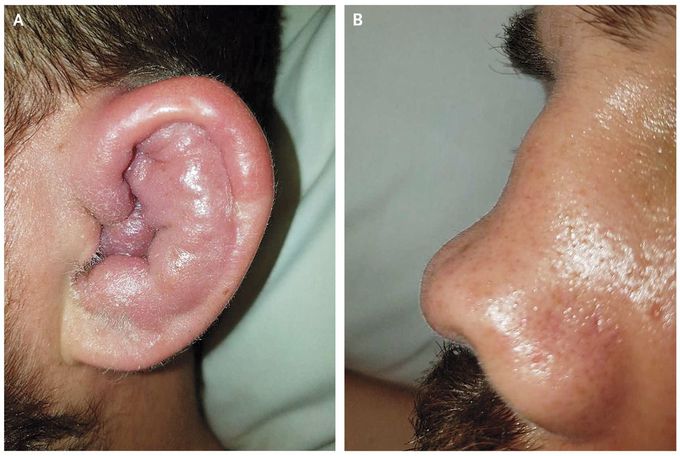 Relapsing Polychondritis
