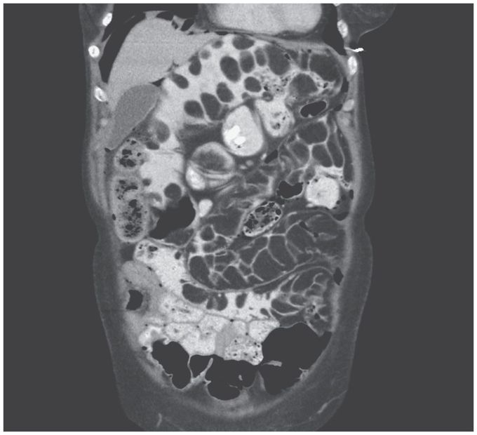 Intestinal Lipomatosis