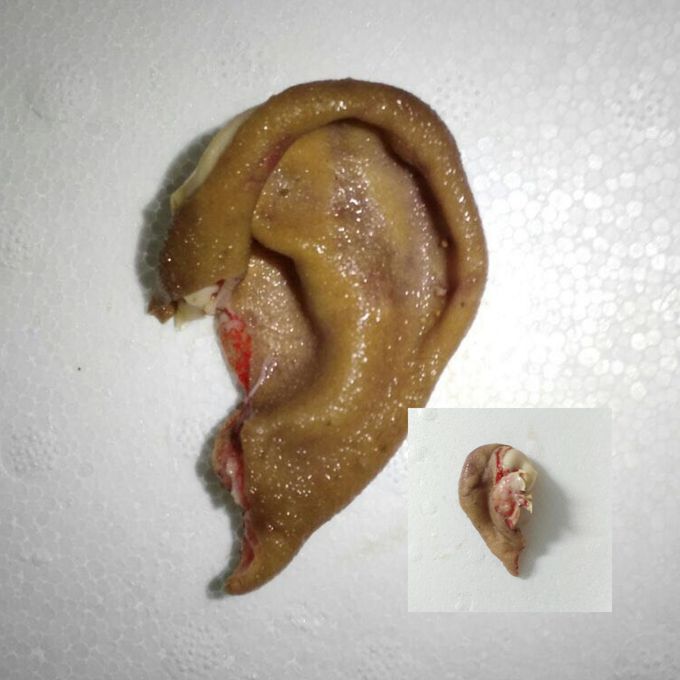 Bitten ear in a street fight.