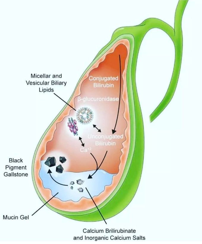 Black Gallstones