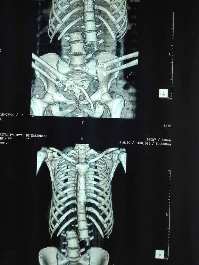 Sectioned spinal cord