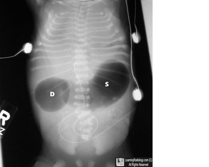 Differential Diagnoses of Double Bubble Sign