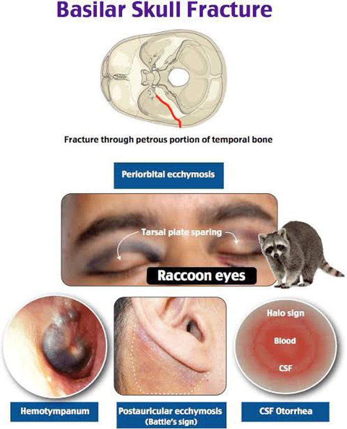 Sign and symptoms of basilar skull fracture