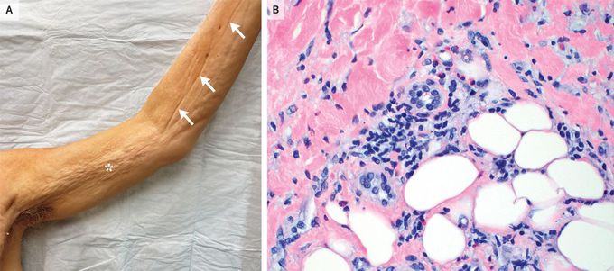 Eosinophilic Fasciitis