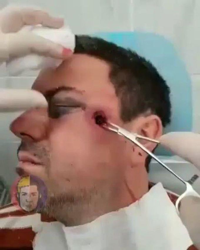 Patient with gunshot wound of the left zygomatic reign