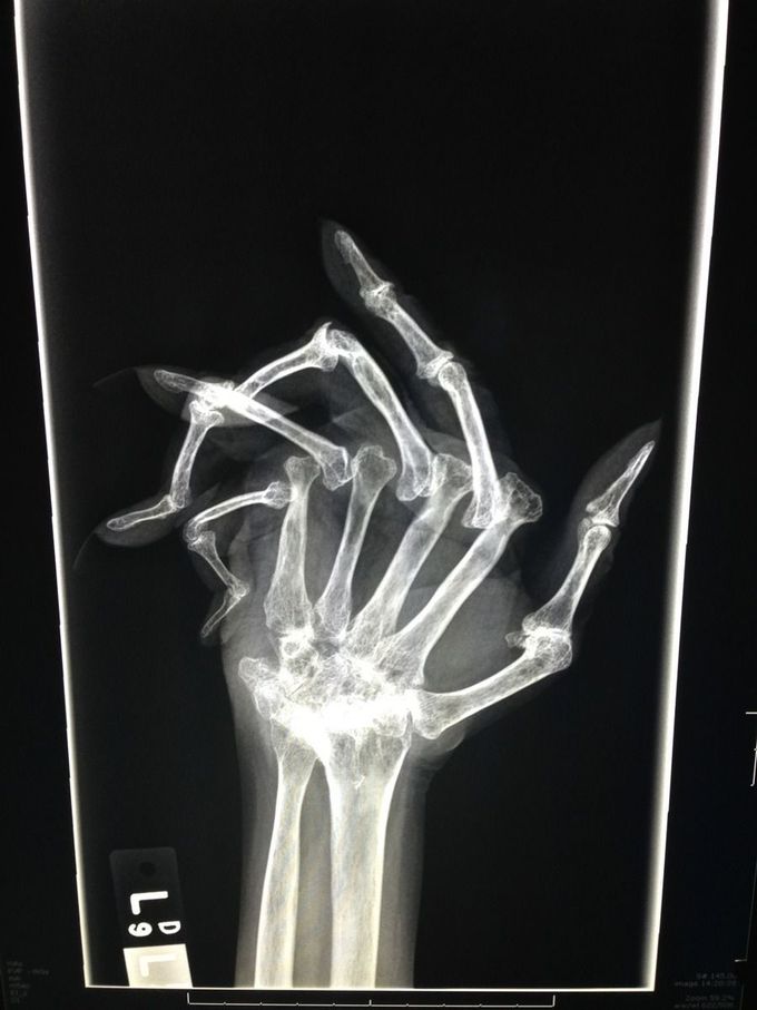 X-Ray of a hand with advanced rheumatoid arthiritis