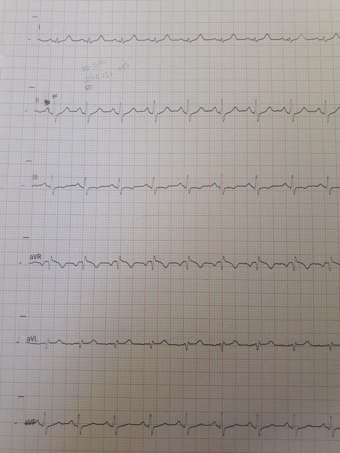 Can smn interpretate this ECG pls?