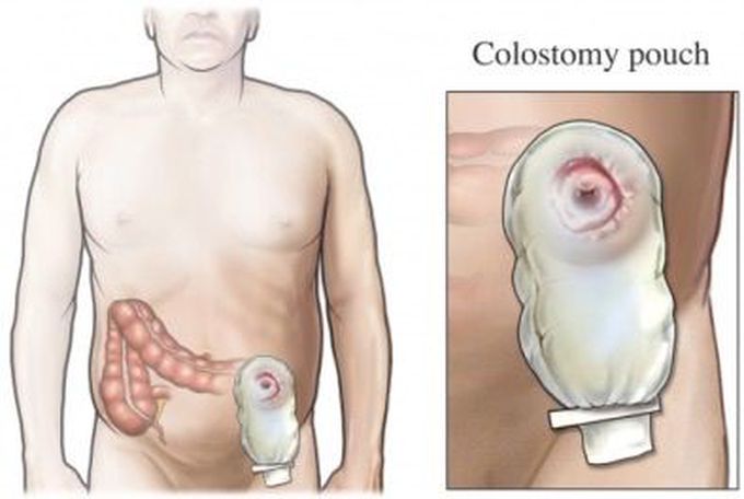 What Is a Colostomy?

A colostomy is a surgical procedure that brings one end of the large intestine out through the abdominal wall. During this procedure, one end of the colon is diverted through an incision in the abdominal wall to create a stoma. A stoma is the opening in the skin where a pouch for collecting feces is attached. People with temporary or long-term colostomies have pouches attached to their sides where feces collect and can be easily disposed of.

Colostomies aren’t always permanent, especially in children with birth defects.

A colostomy can be the result of one of several procedures to correct problems with the lower digestive tract. Other “ostomies” include ileostomy and urostomy. An ileostomy is a diversion of the bottom of the small intestine. A urostomy is a diversion of the tubes that carry urine out of the bladder.

A colostomy may also be referred to as bowel diversion therapy.