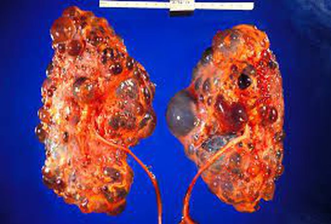 Polycystic kidney disease