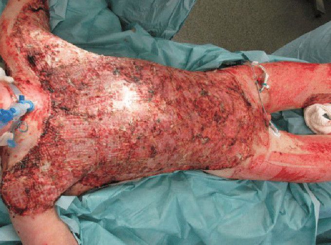 SKIN GRAFT