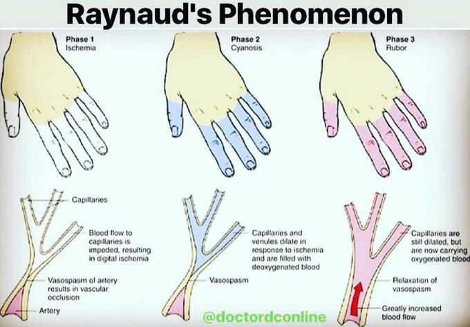 Peripheral Vascular Diseases