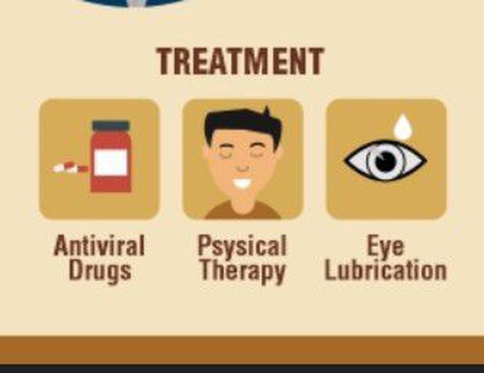 Treatment for Ramsay Hunt syndrome