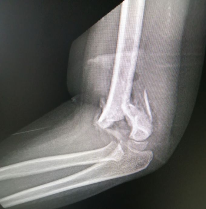Elbow LAT View