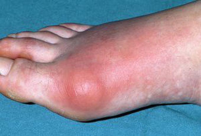 gout treatment