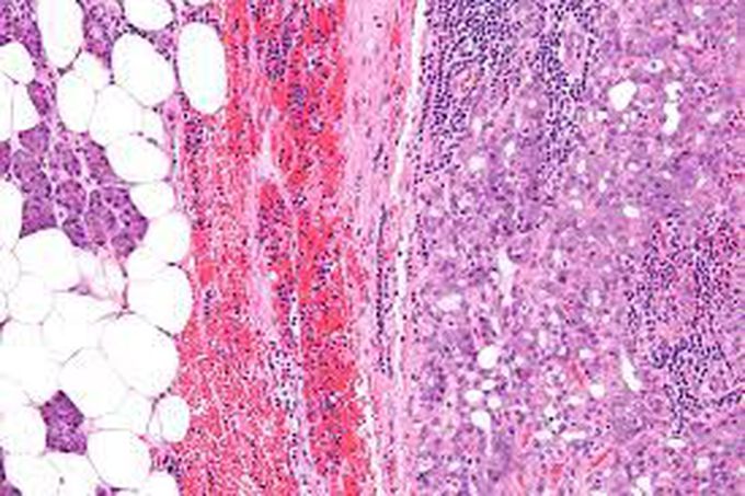 Acinic cell carcinoma