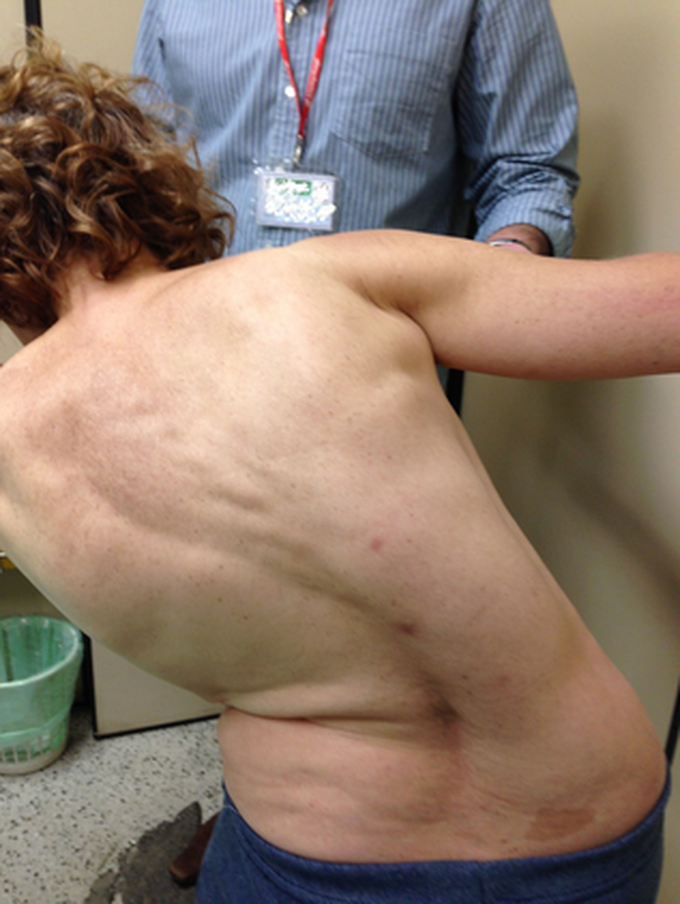 Machado-Joseph disease 