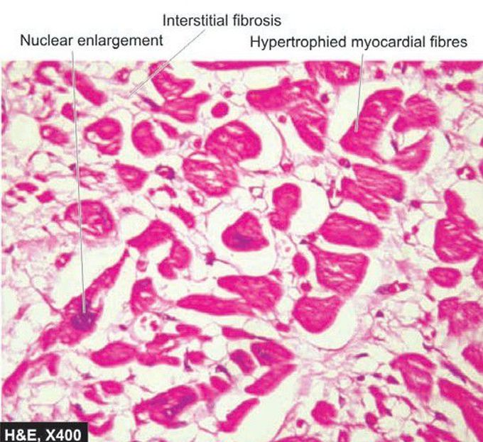 Cardiac hypertrophy