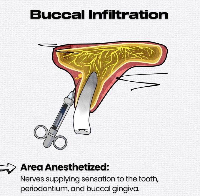 Maxillary Local Anesthesia IV