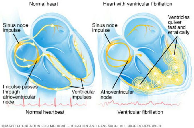 Ventricular Fibrillation