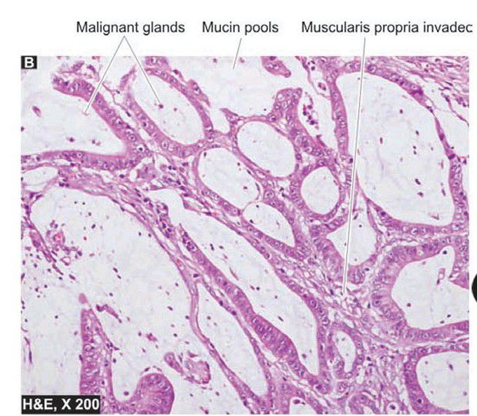 Colonic adenocarcinoma