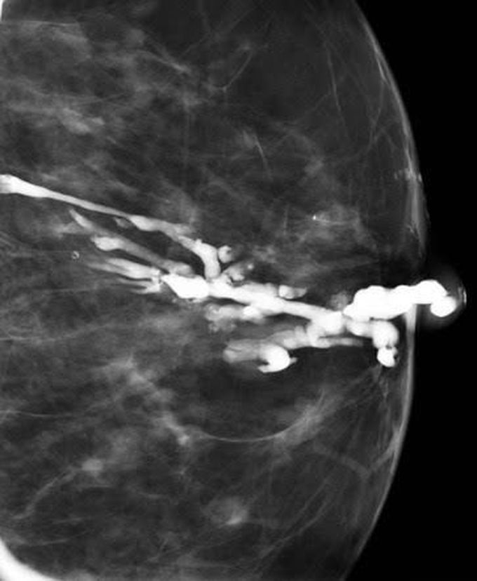 Treatment of duct ectasia