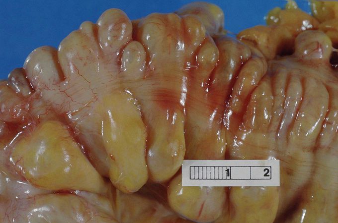 Treatment of diverticulitis