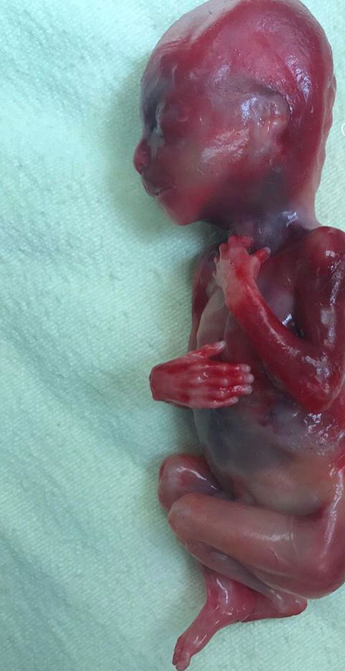 Spontaneous Abortion of a Fetus