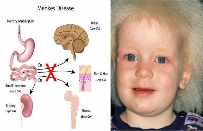 Menkes disease