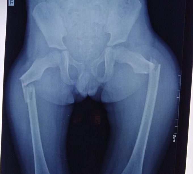 Fracture