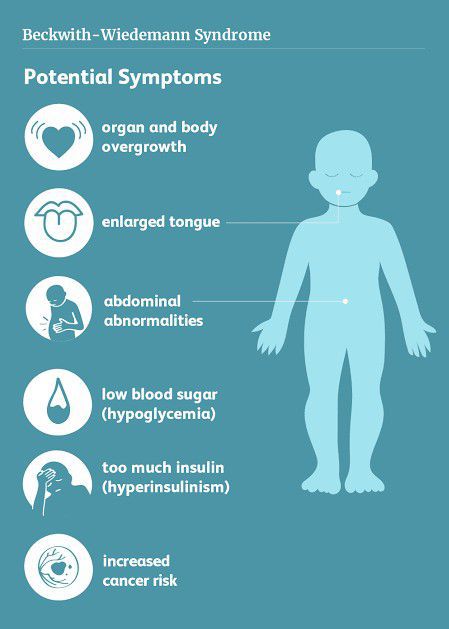 These are the main symptoms of Beckwith-widemann syndrome - MEDizzy