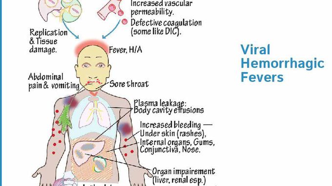 Viral hemorrhagic fever