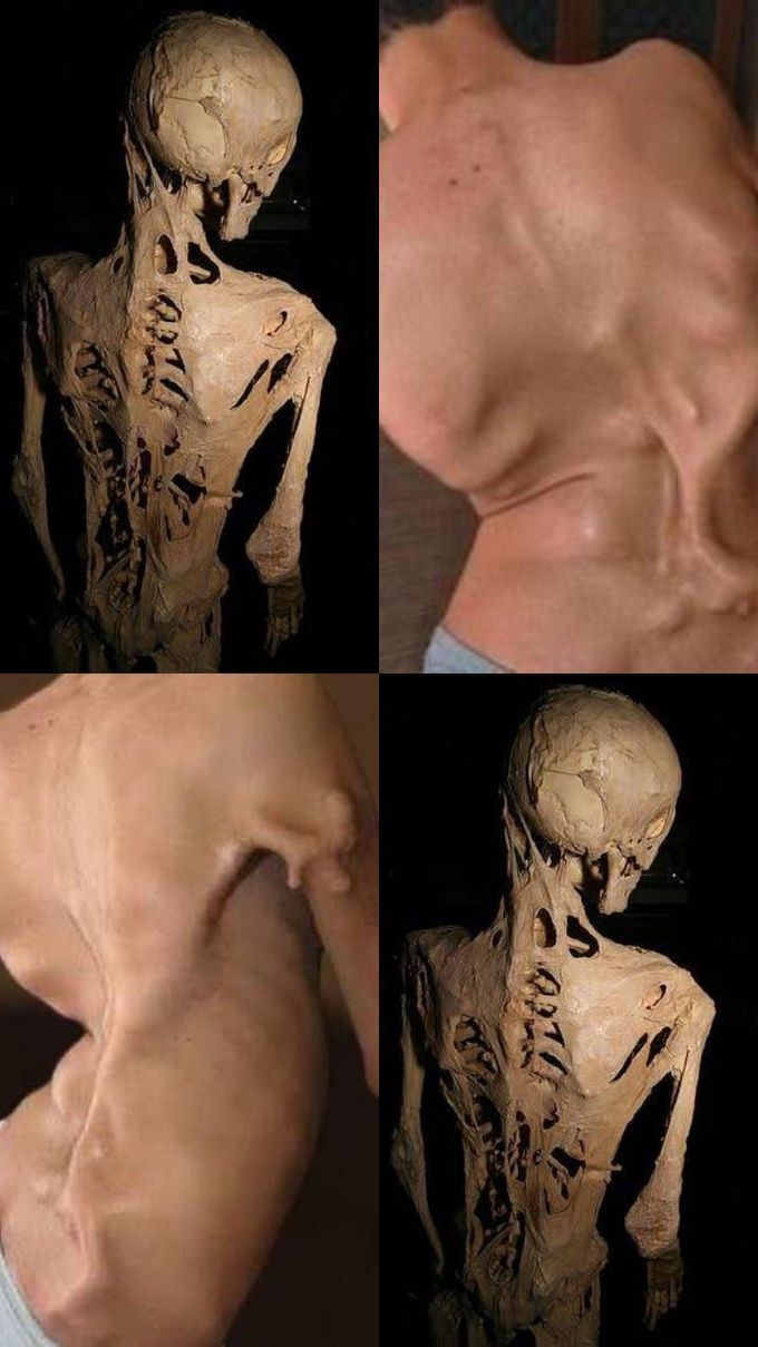 Fibrodysplasia ossificans progressiva