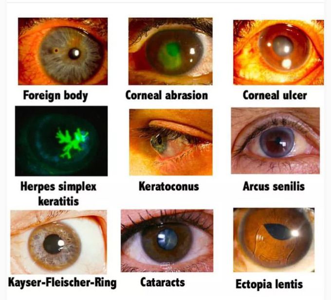 Eyes disorders / diseases - MEDizzy