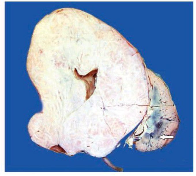 Nephroblastoma