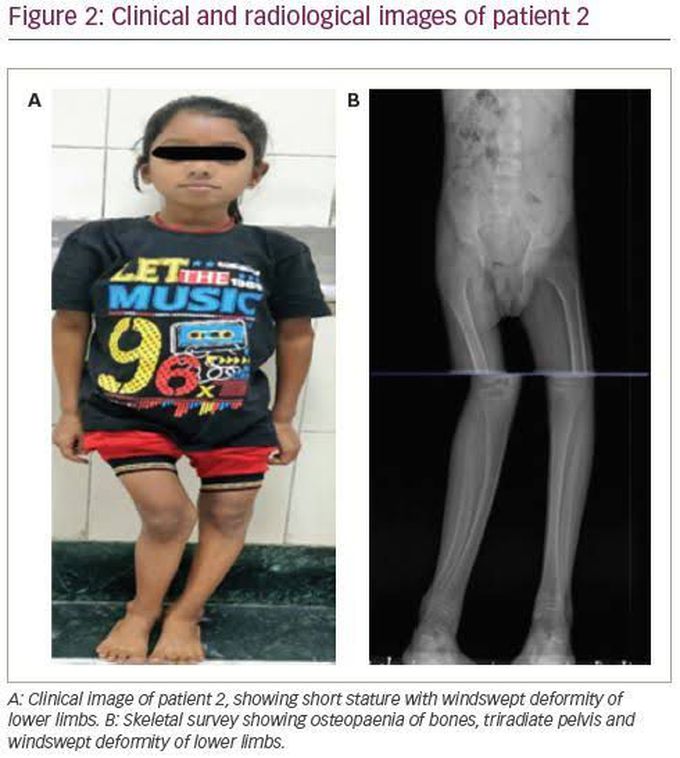 Renal tubular acidosis