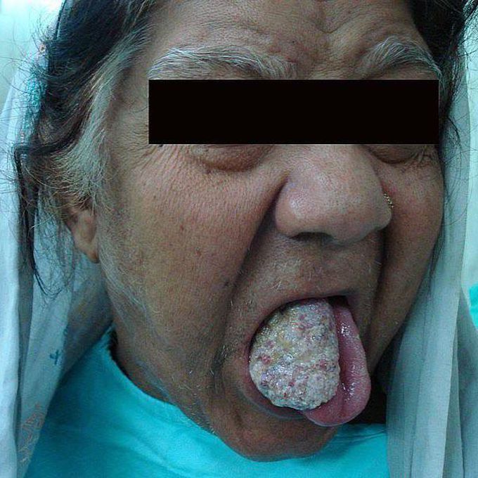 Squamous cell carcinoma of the tongue.