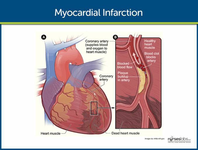 Myocardial Infarction - MEDizzy