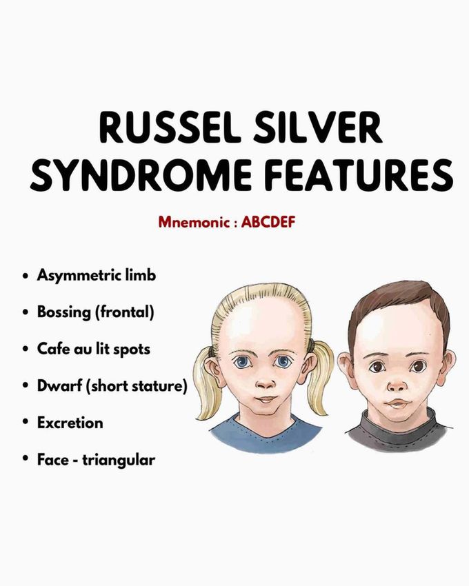 Russel silver syndrome