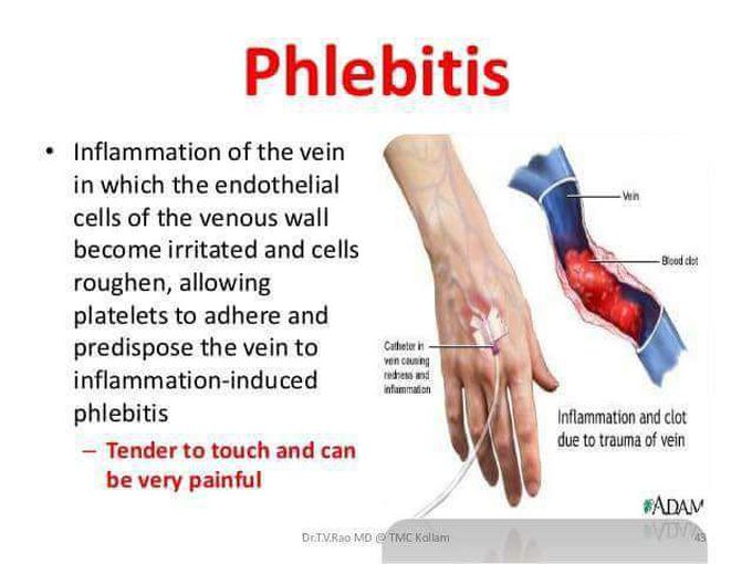 Phlebitis Iv