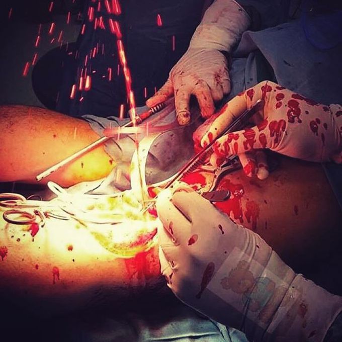 Rupture of an artery during a surgery