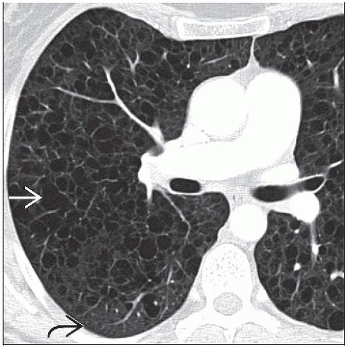 Lymphangioleiomyomatosis