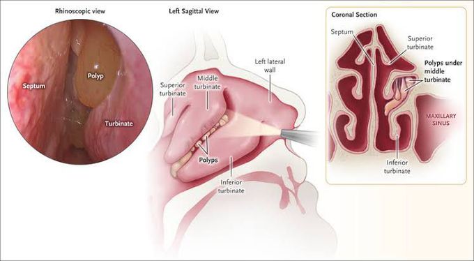 This is what looks like chronic sinusitis with polyps