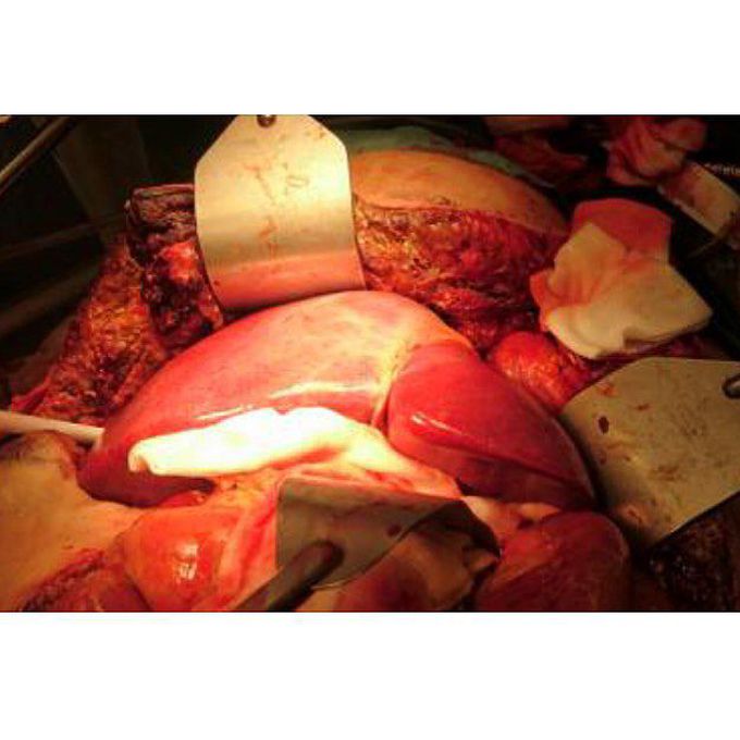 Liver transplant