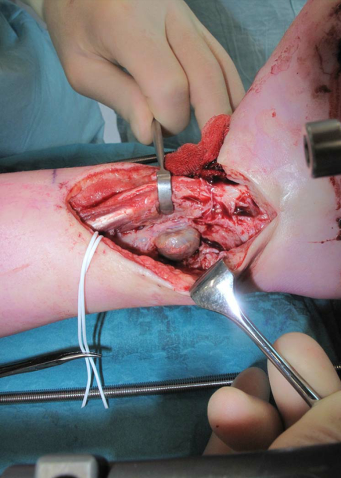 Ipsilateral vascularized fibular transfer performed