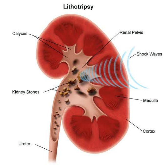 lithotripsy