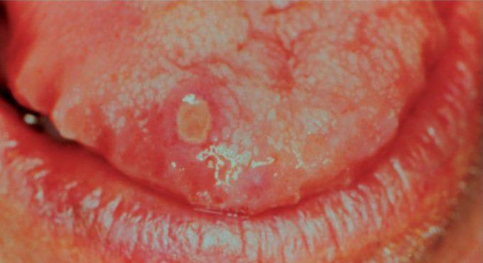 Aphthous ulcer