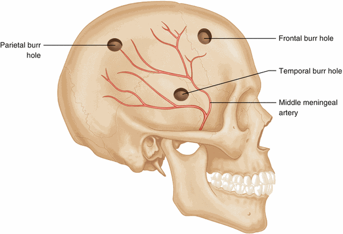 Burr Hole Surgery