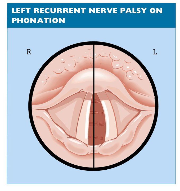 Left recurrent nerve palsy on phonation (mirror view)