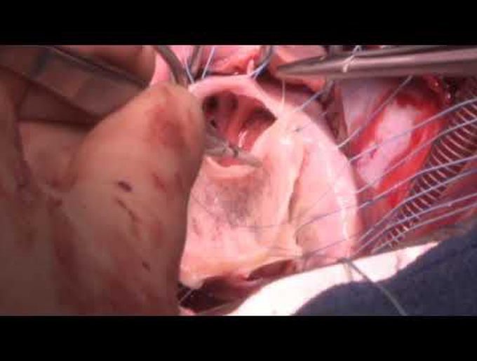 Cormatrix Patch Augmentation of the Tricuspid Valve Anterior Leaflet